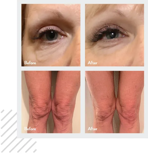 Morpheus8 before and after photos of the skin under the eyes and of the knees