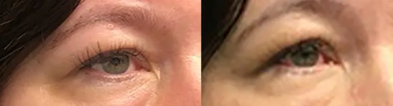 Before and after photos of the upper eyelids