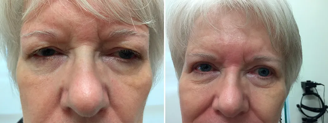 Before and after eyelid surgery: a woman with grey hair, shown before treatment and after