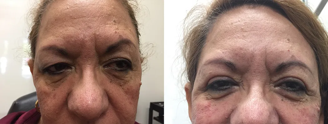 Before and after eyelid surgery: a woman with brown hair, shown before treatment and after