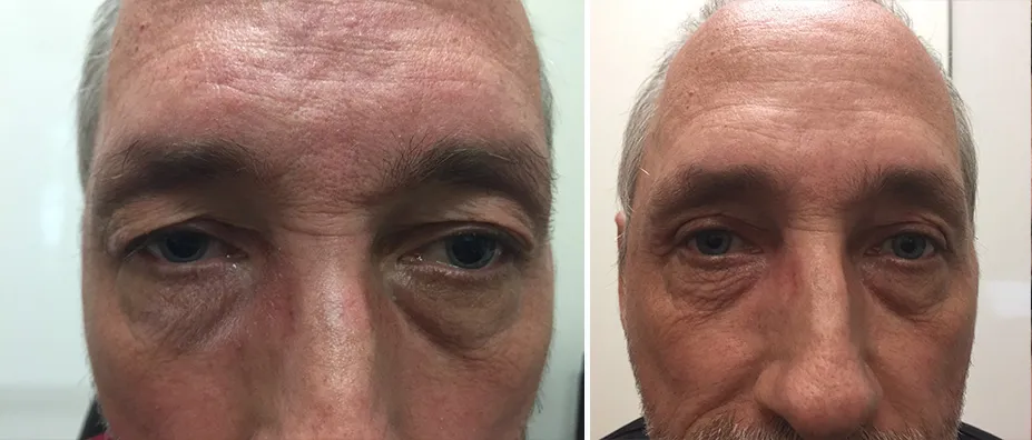 Before and after eyelid surgery: a man with receding grey hair, shown before treatment and after
