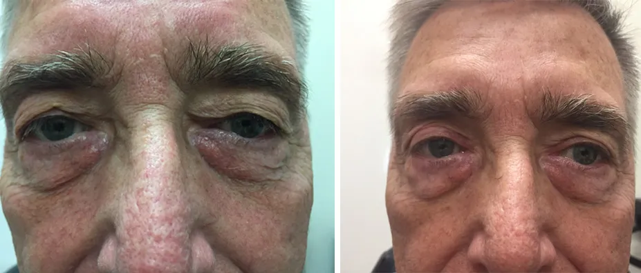 Before and after eyelid surgery: a man with grey eyebrows, shown before treatment and after