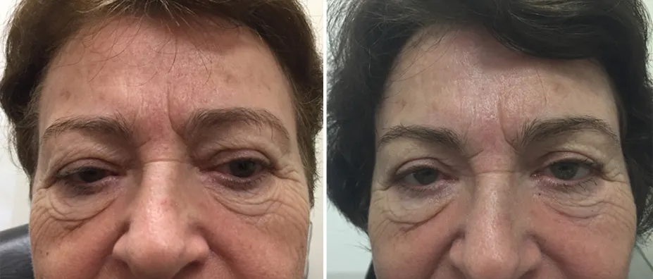 Before and after eyelid surgery: a woman with short dark hair, shown before treatment and after