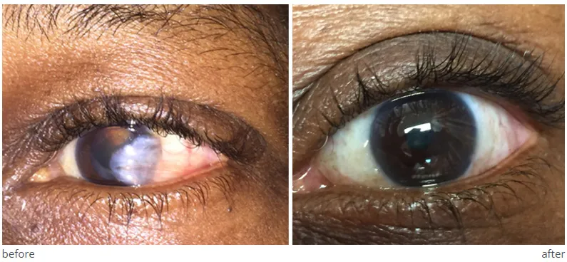 Before and after photos of an eye, with a growth on the surface of the eye shown before surgery and gone after